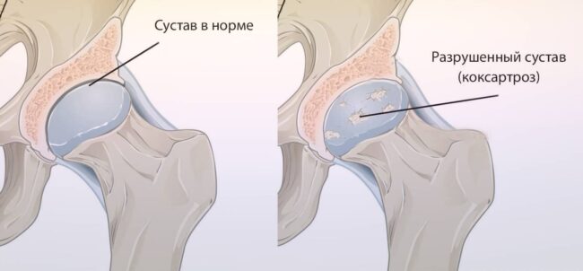 15 народных способов лечения коксартроза