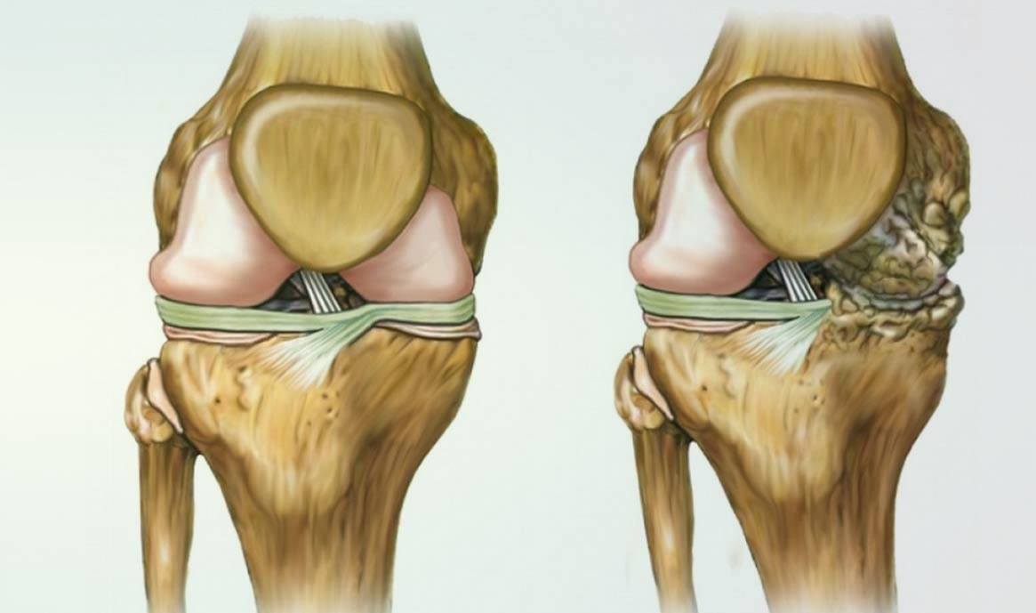 15 способов лечения артроза коленного сустава