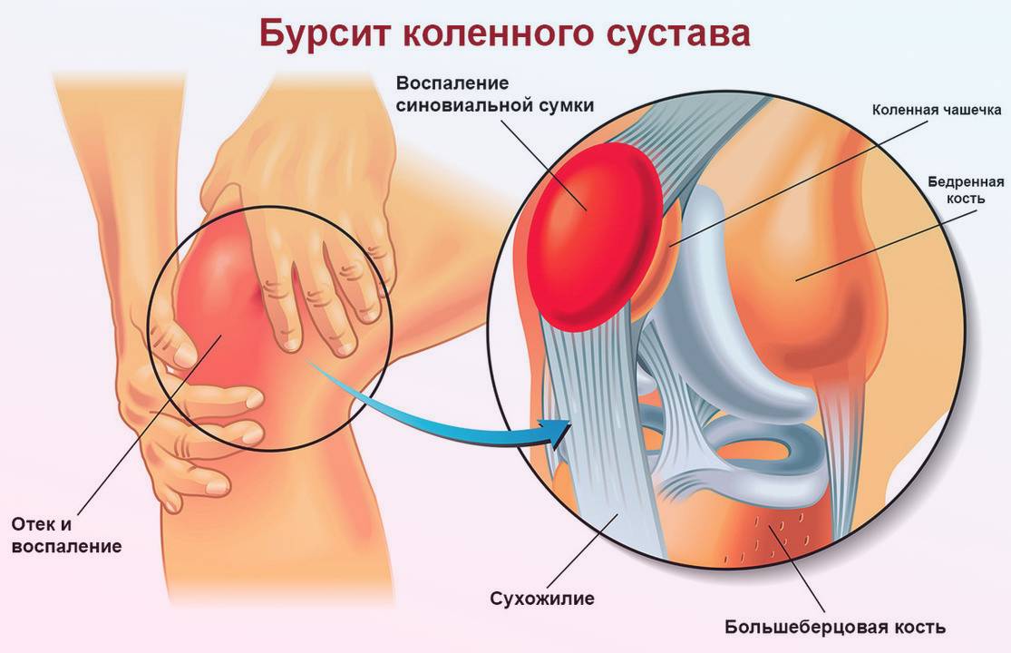 Лечение бурсита коленного сустава